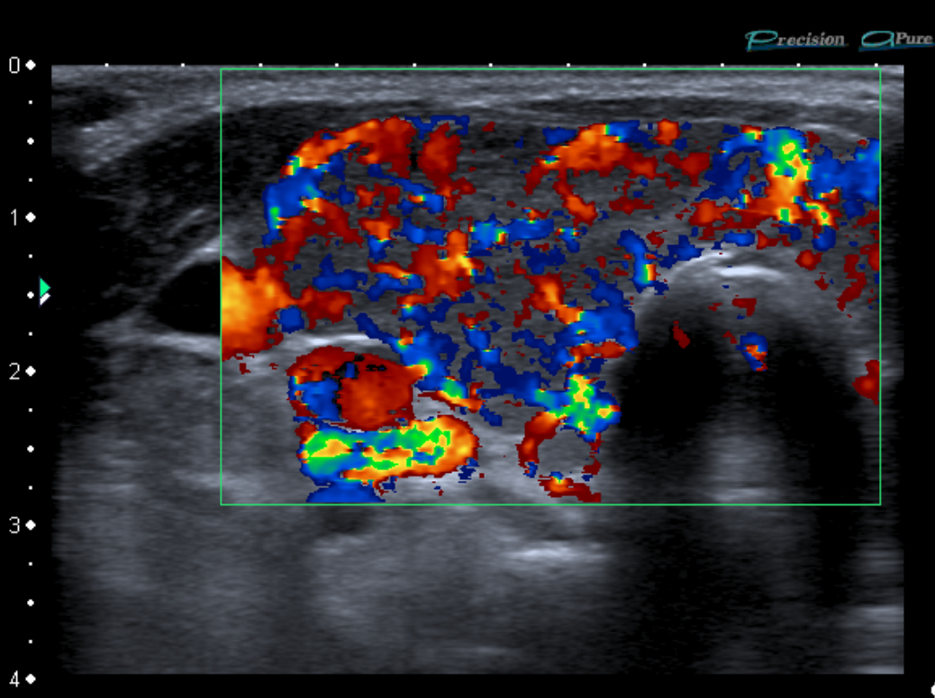 Ultrassonografia com Doppler colorido